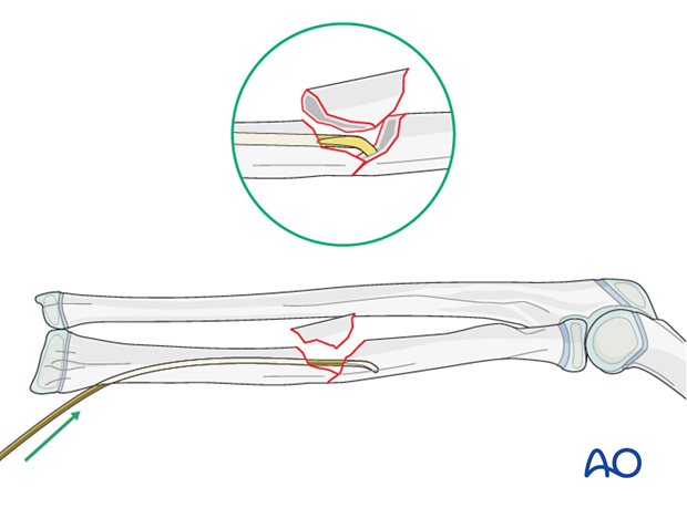 Reduction with nail