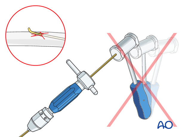 Do not use a hammer if the nail is stuck as this risks iatrogenic fracture.