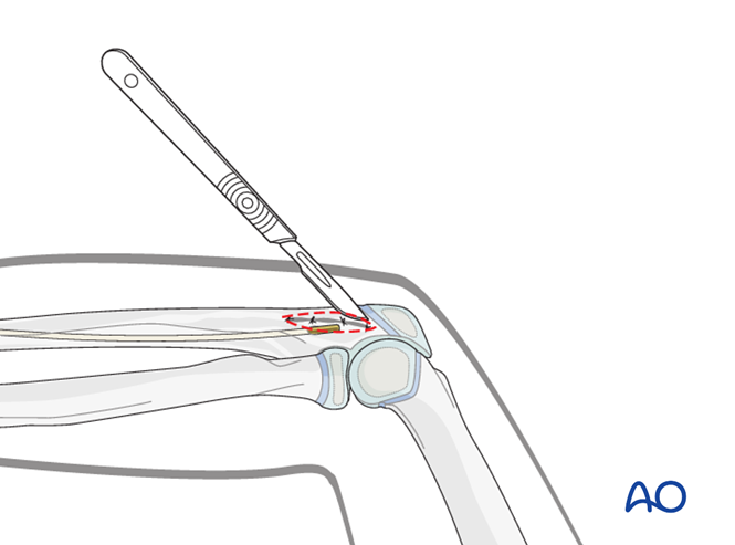 ESIN for Both bones, combination of radial and ulnar fracture