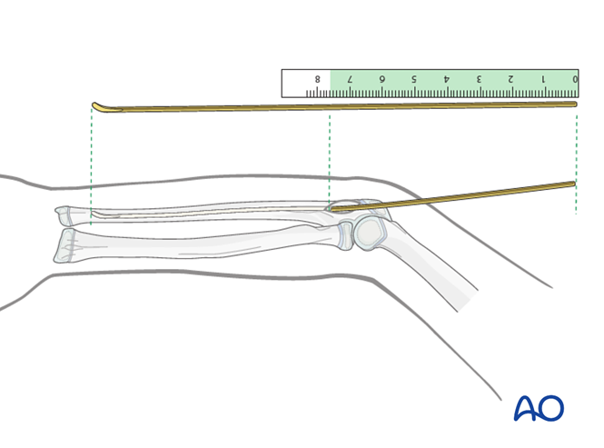 ESIN for Ulna, greenstick