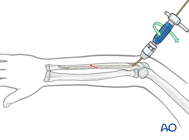ESIN for Ulna, greenstick