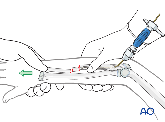 ESIN for Ulna, complete transverse, multifragmentary