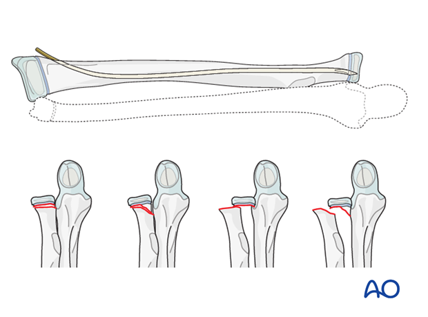 Reduction and fixation of radial head/neck