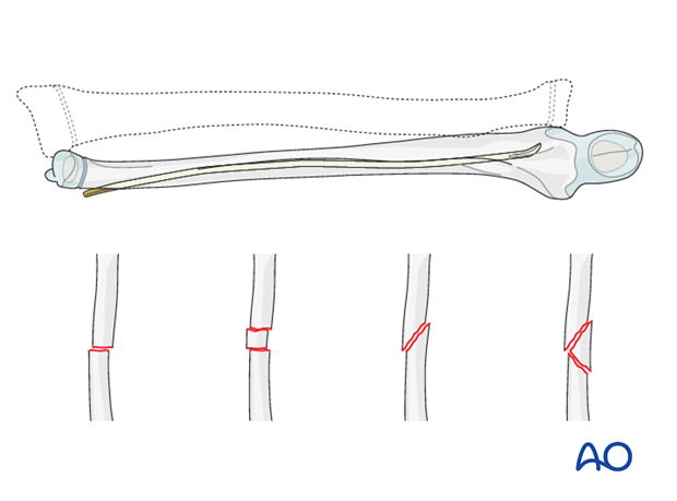 Reduction and fixation of the ulna