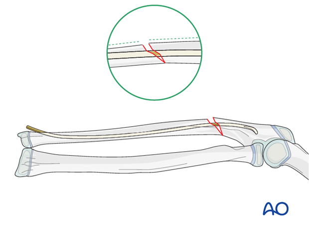 Revision of ulnar reduction and fixation
