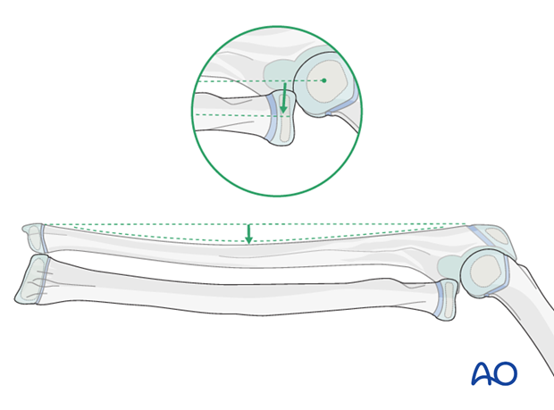 Ulnar osteotomy for plastic deformity