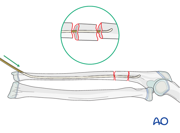 Reduction with nail