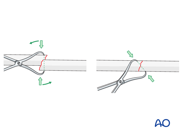 Open reduction by twisting a reduction forceps