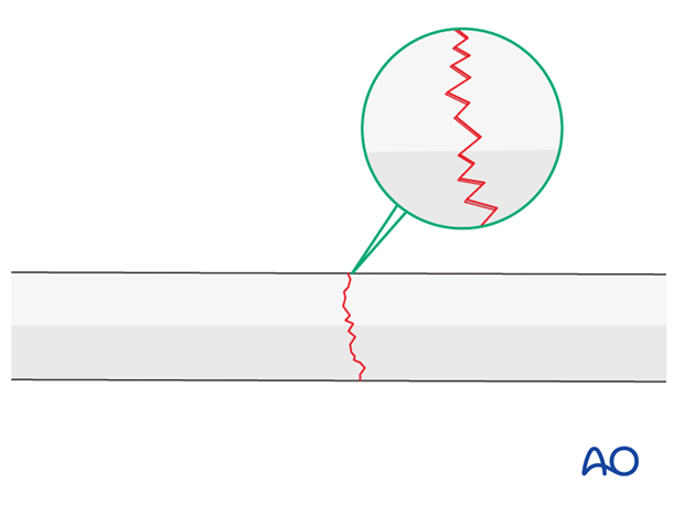 Maintaining fracture reduction