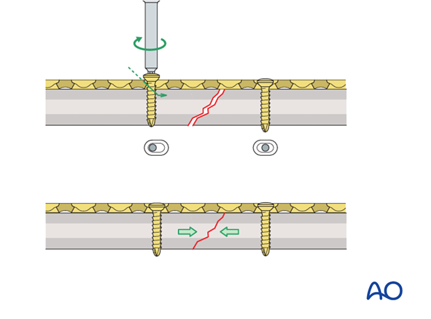 Compression plating