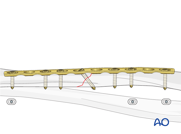 Completed osteosynthesis