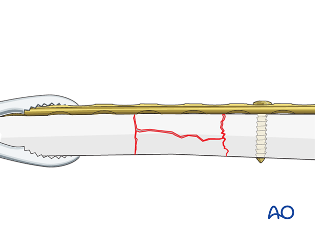 Maintaining fracture reduction with plate