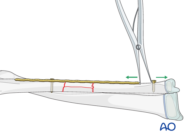 Plate assisted reduction and distraction using a laminar spreader and a screw (push-pull technique)