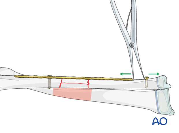 Plate assisted reduction and distraction using a laminar spreader and a screw (push-pull technique)