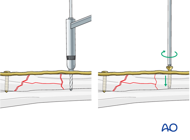 Insertion of 2nd screw