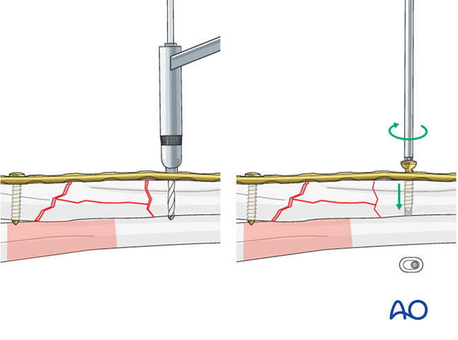 Radius, multifragmentary fracture: open reduction, bridge plating
