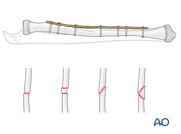 Reduction and fixation of the radius