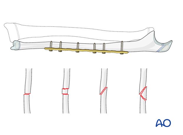 Reduction and fixation of the ulna