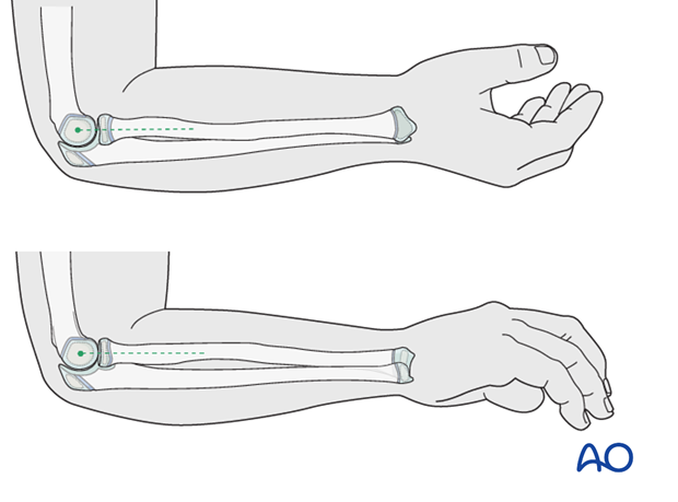 Assessing the radial head position