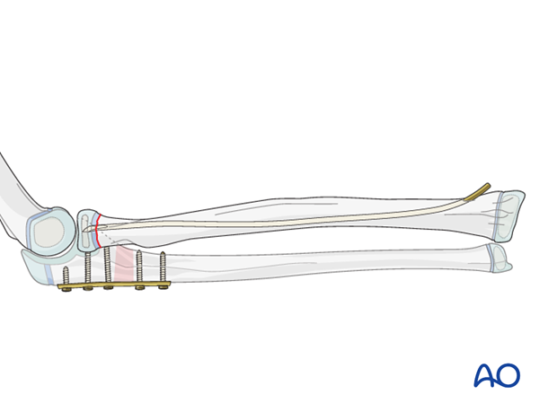 Plating of the ulna and ESIN of the radial head