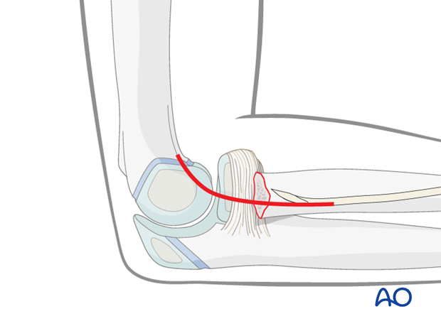 Lateral approach to the proximal radius