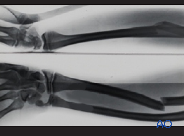 Complete transverse fracture of the radius and bowing of the ulna