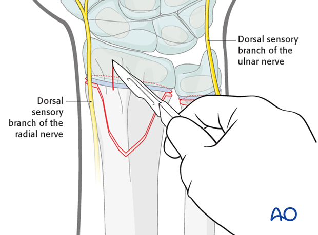 closed reduction k wire fixation