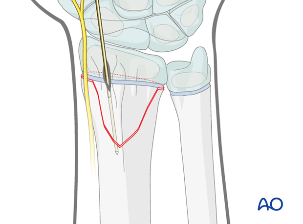 closed reduction k wire fixation