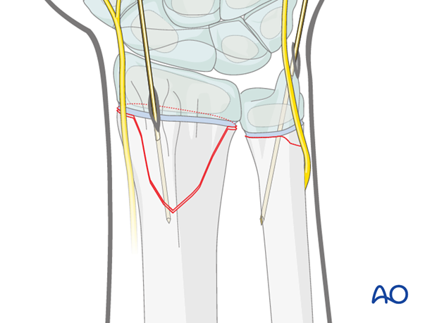 closed reduction k wire fixation