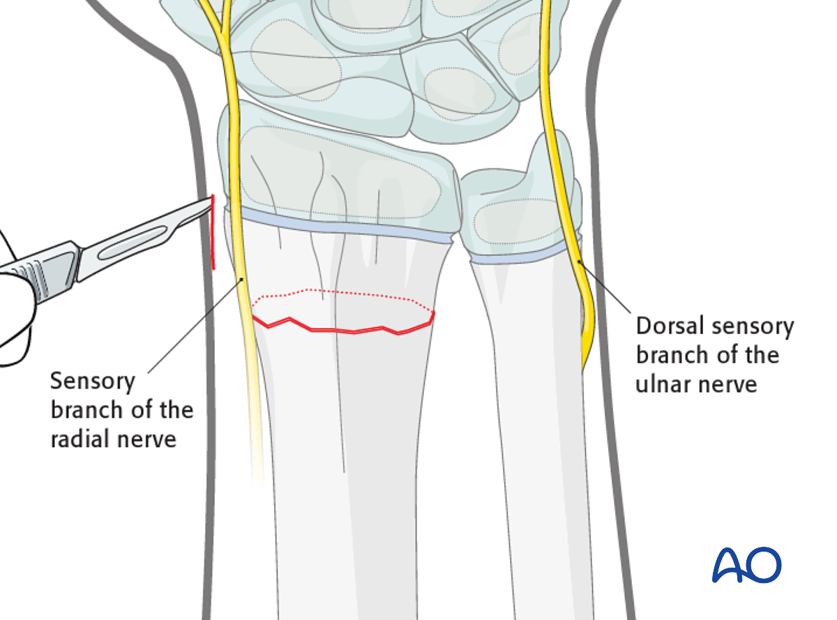 Open Reduction; K-wire Fixation For Metaphyseal, Simple Complete, Radius