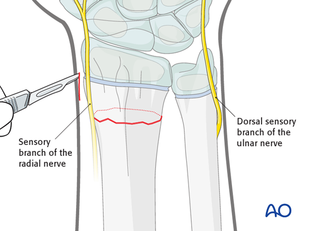 closed reduction k wire fixation