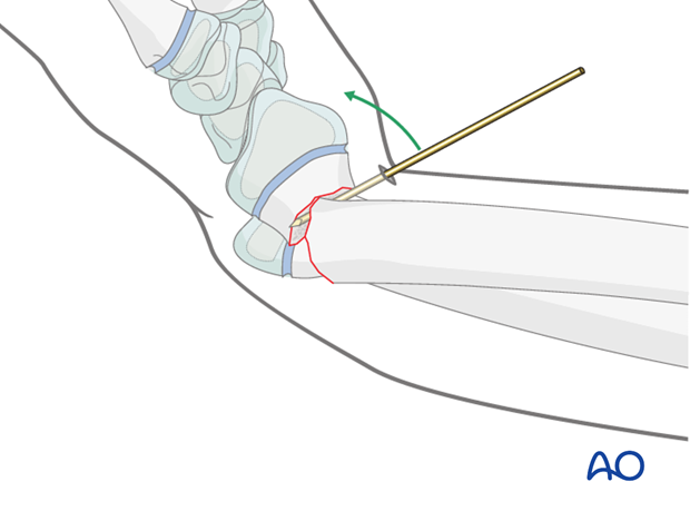 closed reduction k wire fixation