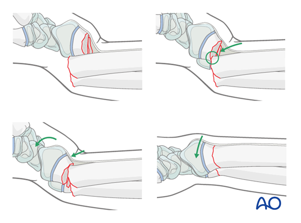 closed reduction k wire fixation