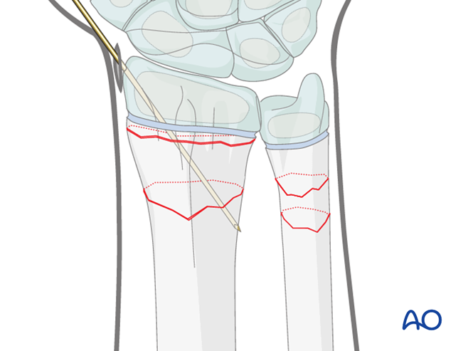Open reduction; K-wire fixation for Metaphyseal, multifragmentary ...