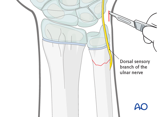 Closed reduction; K-wire fixation for Metaphyseal, simple complete, ulna