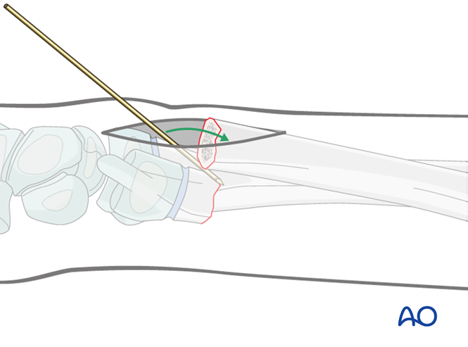 Open Reduction K Wire Fixation For Metaphyseal Simple Complete Ulna