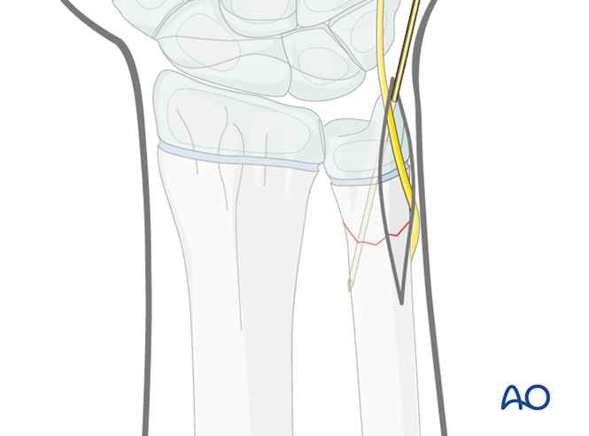 Open reduction; K-wire fixation for Metaphyseal, simple complete, ulna