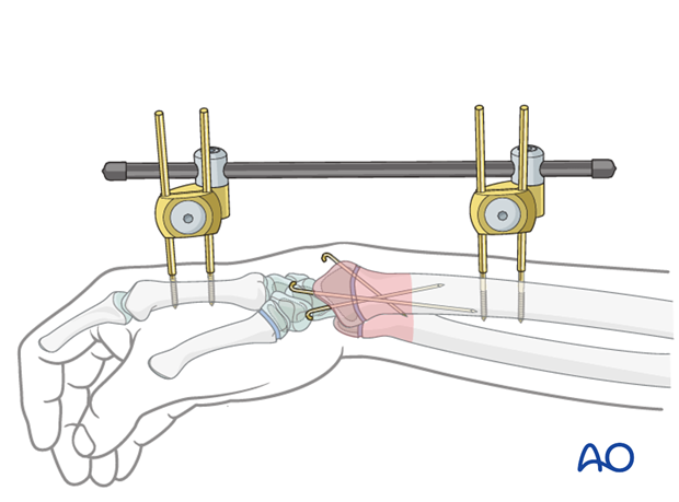 external fixation