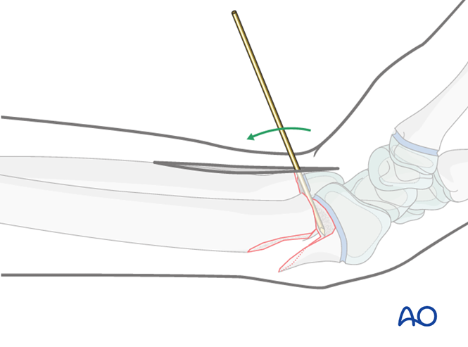 Open Reduction K Wire Fixation For Simple Epiphysiolysis With