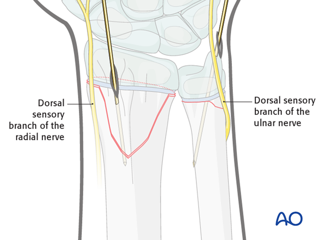 Open reduction; K-wire fixation for Simple epiphysiolysis with ...