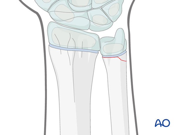 closed reduction k wire fixation