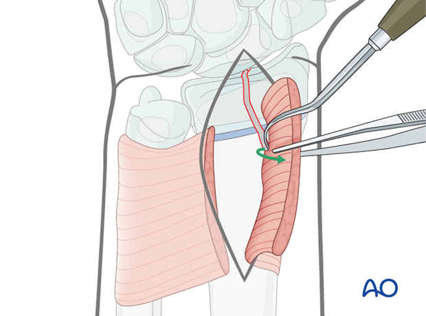 open reduction k wire fixation