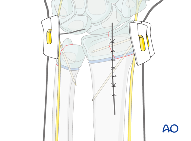 open reduction k wire fixation