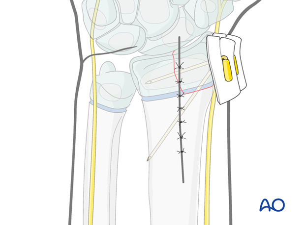 open reduction k wire fixation