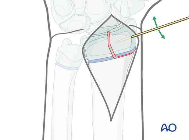 open reduction k wire fixation