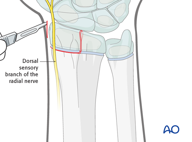closed reduction k wire fixation