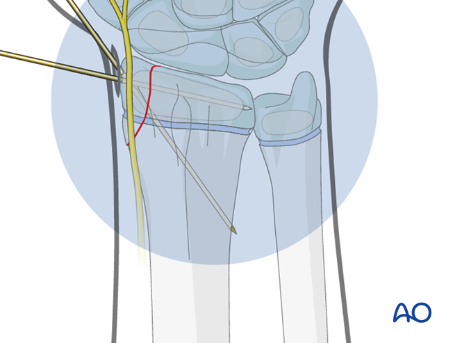 Closed Reduction K Wire Fixation For Simple Epi Metaphyseal Fracture