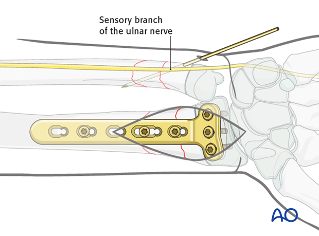 open reduction plate fixation