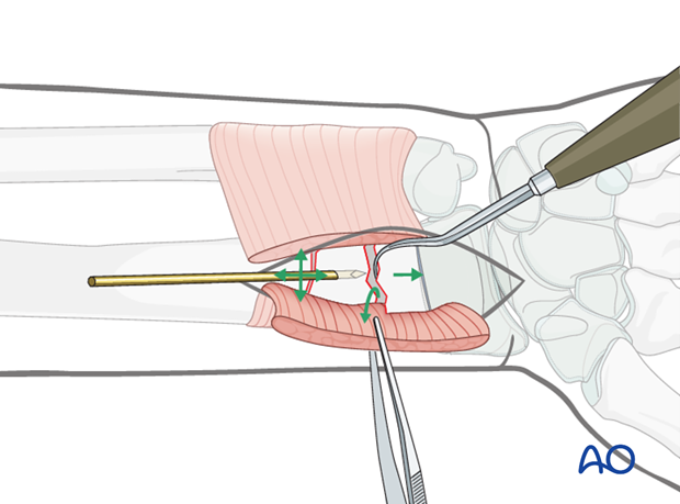 open reduction plate fixation