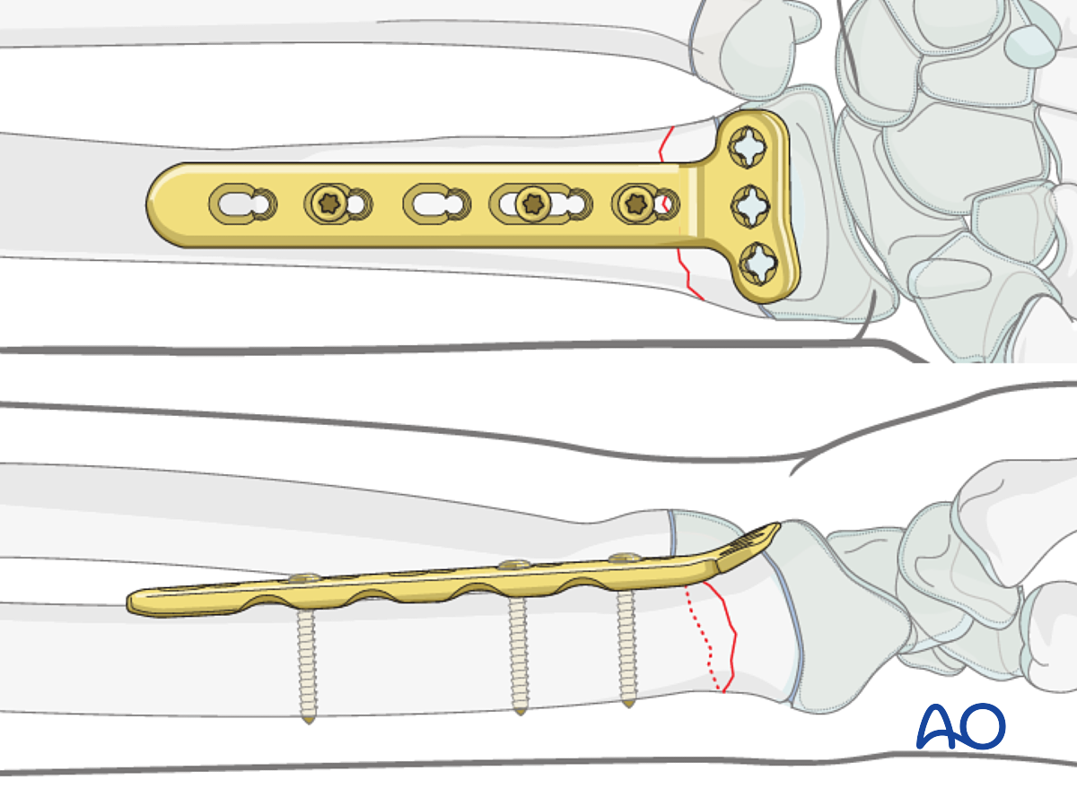 Open Reduction; Plate Fixation For Metaphyseal, Simple Complete, Radius